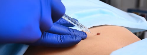 Mohs-Injection-Skin-Cancer-Mole-iStock-1297553950-1